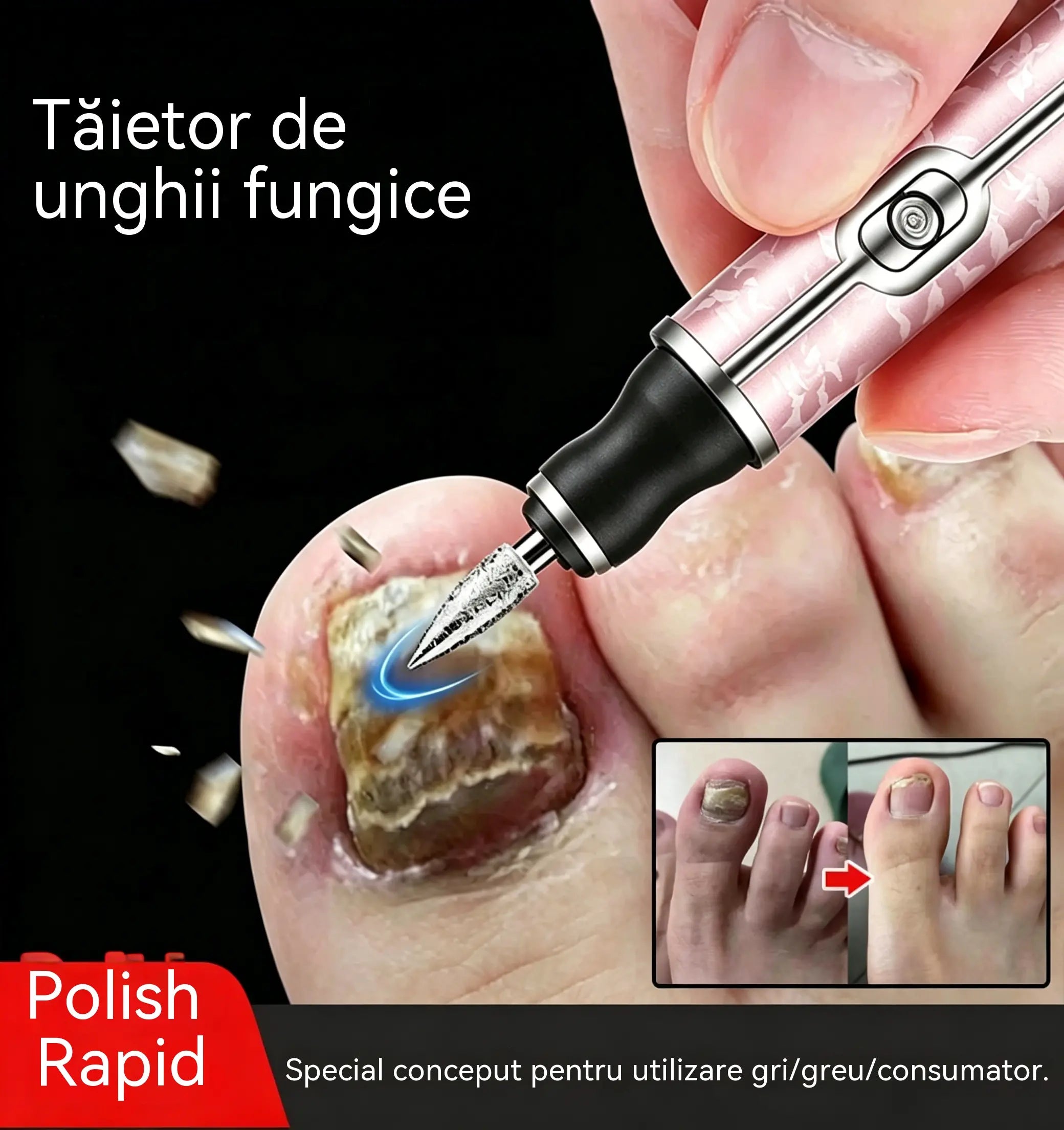 💅👍👍Pilă electrică de unghii pentru tratamentul onicomicozei